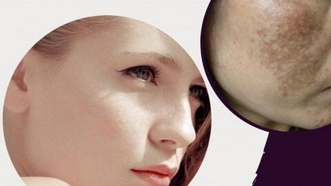 Thiamidol có tác dụng gì trong điều trị nám từ sâu bên trong?
