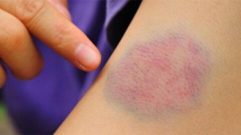 Vết bầm tím trên da - chớ coi thường