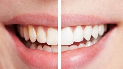 Cách lấy cao răng tại nhà từ chanh và giấm