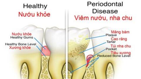 Bệnh nha chu và cách phòng, trị