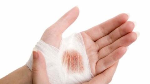 Một số vị thuốc có tác dụng cầm máu tại chỗ