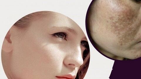 Thiamidol có tác dụng gì trong điều trị nám từ sâu bên trong?