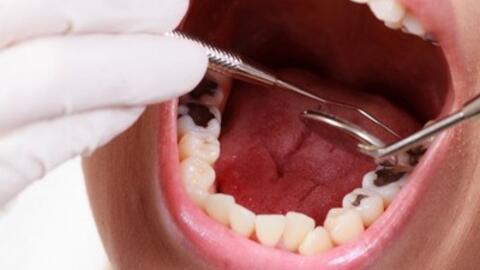 Chữa sâu răng hiệu quả bất ngờ chỉ với nguyên liệu vườn nhà