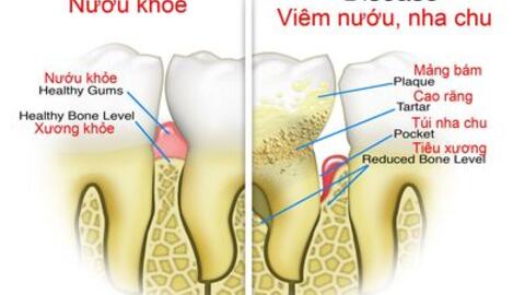 Bệnh nha chu và cách phòng, trị