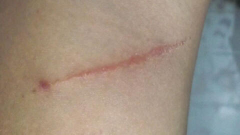 Mẹo hay chữa bệnh giời leo