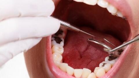 Chữa bệnh sâu răng bằng mẹo dân gian