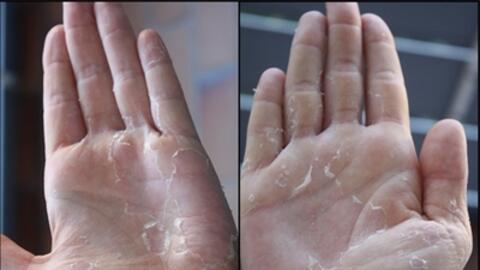 Bong tróc da tay - nguyên nhân và cách chữa trị