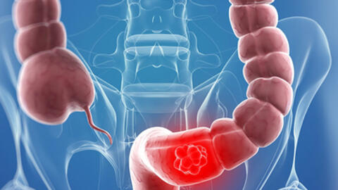 Viêm đại tràng và những bài thuốc quý cho mọi người