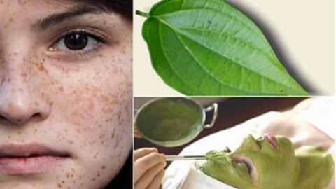 Trị nám, tàn nhang bằng lá trầu không