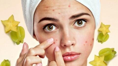 Trị mụn nhọt mùa hè bằng cây lá quanh ta