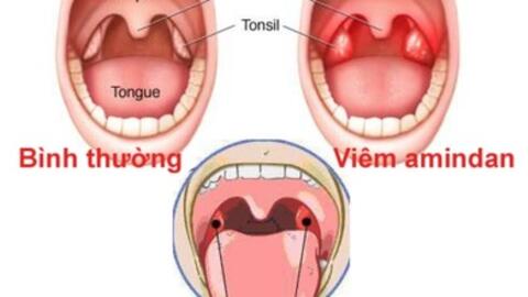 Những bài thuốc dân gian hay chữa viêm amidan