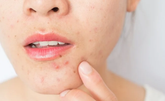 Hiện tượng bùng phát mụn có thể xảy ra khi áp dụng cách sử dụng Retinol